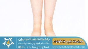 درمان لنف ادم در فاز نگهدارنده