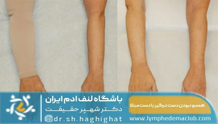 عوامل خطرزای لنف ادم ؛ عوامل تاثیرگذار بر لنف ادم اندام تحتانی و پاها