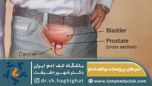 لنف ادم بعد از سرطان پروستات