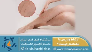 تصویر پا مبتلا به لنف ادم و توضیح تفاوت واریس و لنف ادم