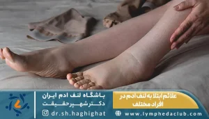 تصویر فرد درگیر به لنف ادم و توضیح علائم لنف ادم
