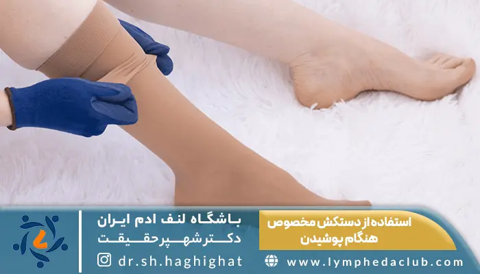 بیمار در حال استفاده از دستکش مخصوص هنگام پوشیدن جوراب لنف ادم