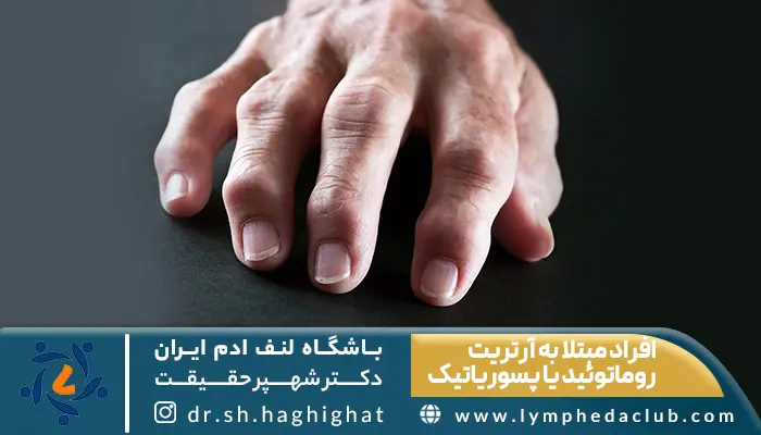 افراد مبتلا به آرتریت روماتوئید که کاندیدای لنف ادم هستند