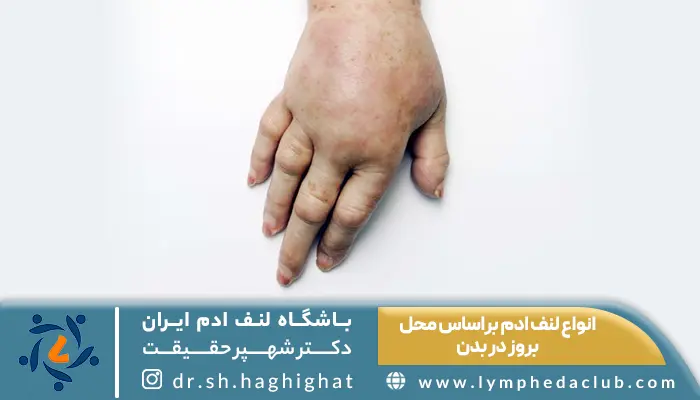 دست دارای ورم یکی از انواع لنف ادم