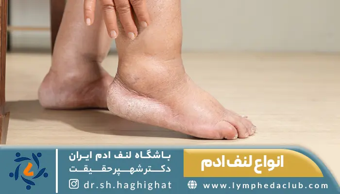 فرد مبتلا به ورم پا یکی از انواع لنف ادم