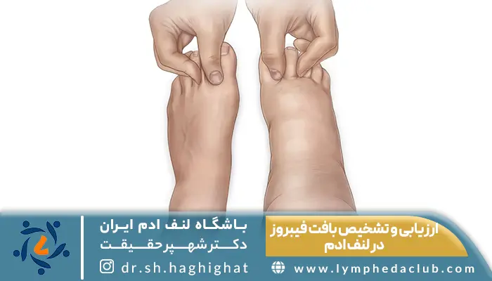 ارزیابی و تشخیص بافت فیبروز در لنف ادم