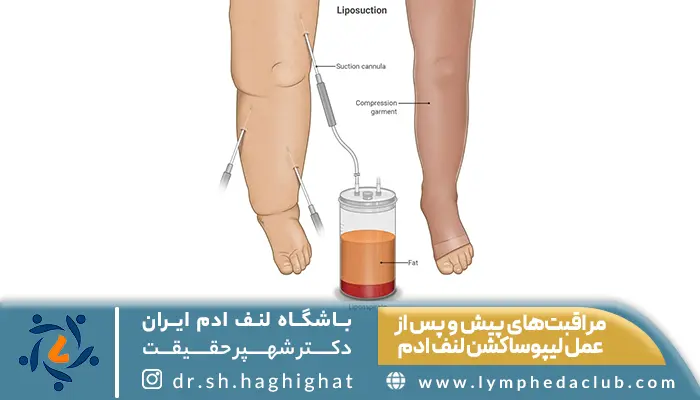 وکتور درمان لنف ادم با لیوپساکشن و توضیح مراقبت‌های پیش و پس از عمل لیپوساکشن لنف ادم