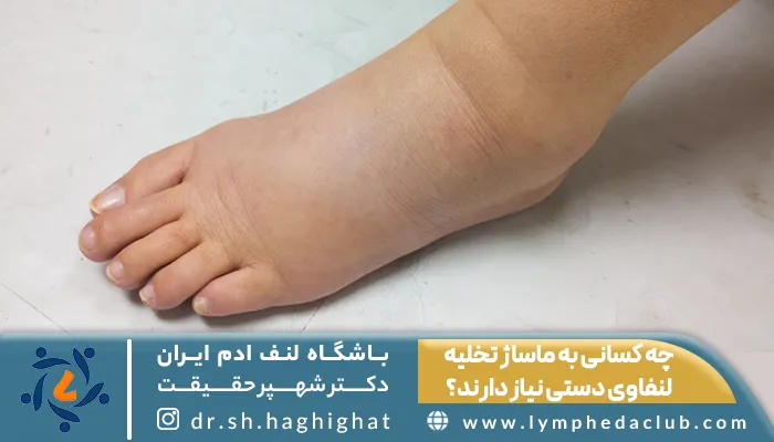 تصویر پا دارای لنف ادم 