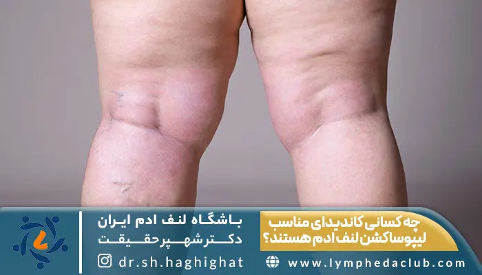 چه کسانی کاندیدای مناسب لیپوساکشن لنف ادم هستند؟