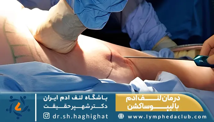 جراح در حال درمان لنف ادم با لیپوساکشن