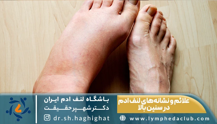 پای ورم کرده از علائم لنف ادم در سنین بالا