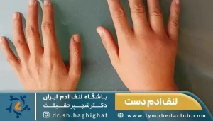 لنف ادم دست