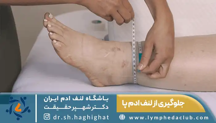 اندازه گیری ورم مچ پا با متر برای شروع جلوگیری از لنف ادم پا