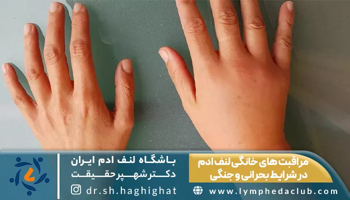 مراقبت از لنف ادم در شرایط جنگی